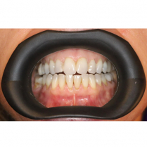 VisionButler Mouth Retractor